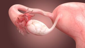 Normal Size of Ovary - Feature - TCP