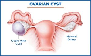 Normal Size of Ovary - Descriptive 3 - TCP